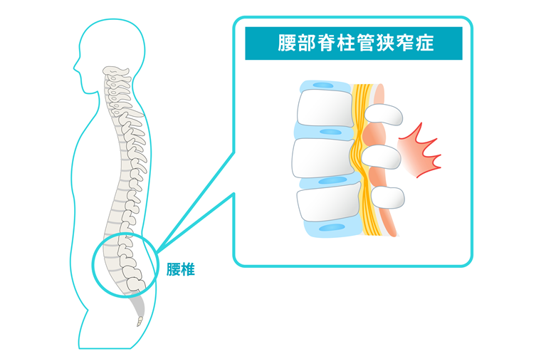 腰部脊柱管狭窄症とは