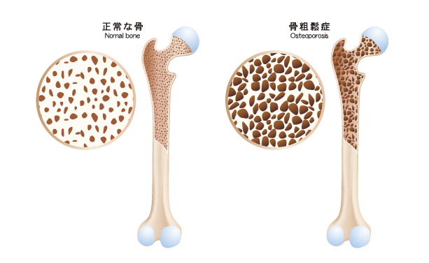 骨粗鬆症とは
