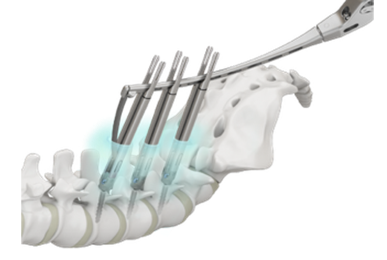 低侵襲脊椎固定術